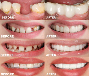 BrightBite - EasyClick Denture Solution